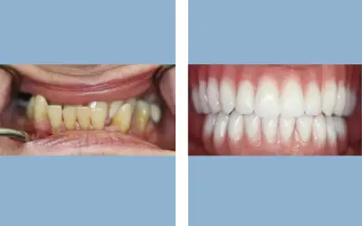 Before and After